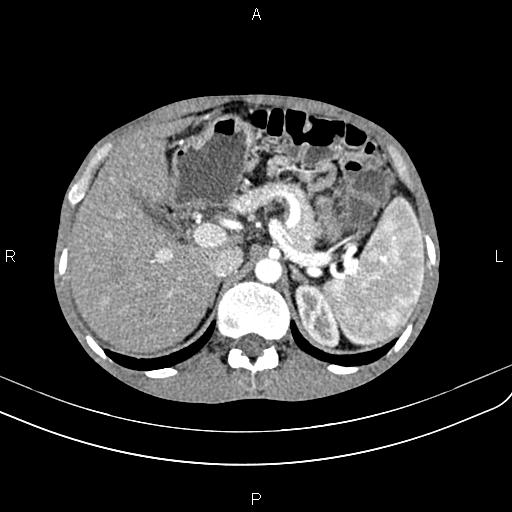 Active crohn disease (Radiopaedia 87133-103397 Axial C+ arterial phase 30).jpg