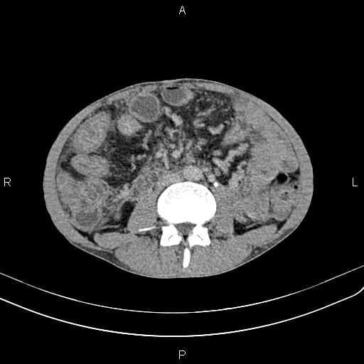 Active crohn disease (Radiopaedia 87133-103397 Axial C+ delayed 32).jpg