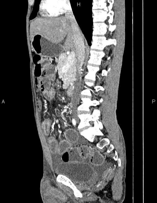 Active crohn disease (Radiopaedia 87133-103397 Sagittal C+ arterial phase 39).jpg