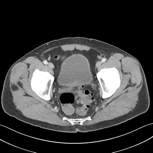 File:Active diverticular hemorrhage (Radiopaedia 39415-41725 Axial C+ portal venous phase 63).png