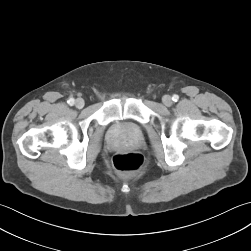 File:Active diverticular hemorrhage (Radiopaedia 39415-41725 Axial C+ portal venous phase 71).png