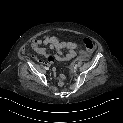 File:Active renal extravasation with large subcapsular and retroperitoneal hemorrhage (Radiopaedia 60975-68796 Axial 278).jpg