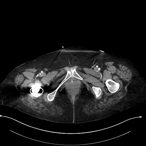 File:Active renal extravasation with large subcapsular and retroperitoneal hemorrhage (Radiopaedia 60975-68796 Axial C+ arterial phase 206).jpg