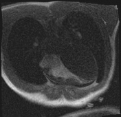 File:Active right ventricular cardiac sarcoidosis (Radiopaedia 55596-62100 Axial Dynamic perfusion scan MOCO 28).jpg