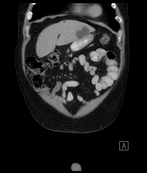 Acute-on-chronic pancreatitis (Radiopaedia 67286-76656 Coronal C+ portal venous phase 22).jpg