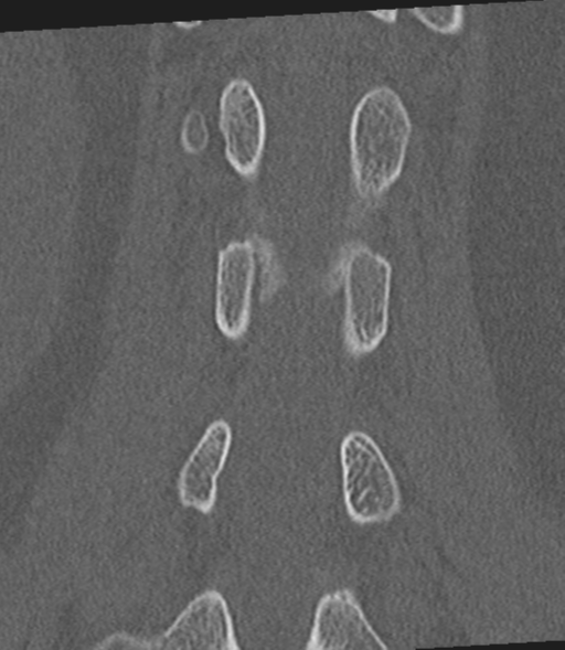 File:Acute L1 burst compression fracture (Radiopaedia 34430-35755 Coronal bone window 37).png