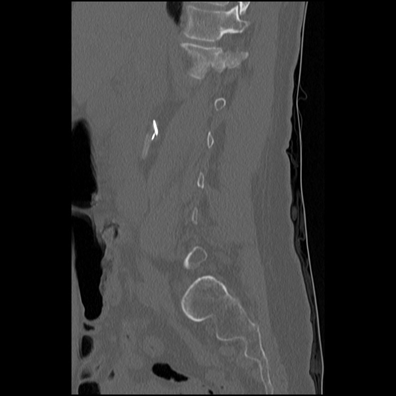 Acute Schmorl's node (Radiopaedia 83276-102365 Sagittal bone window 53).jpg