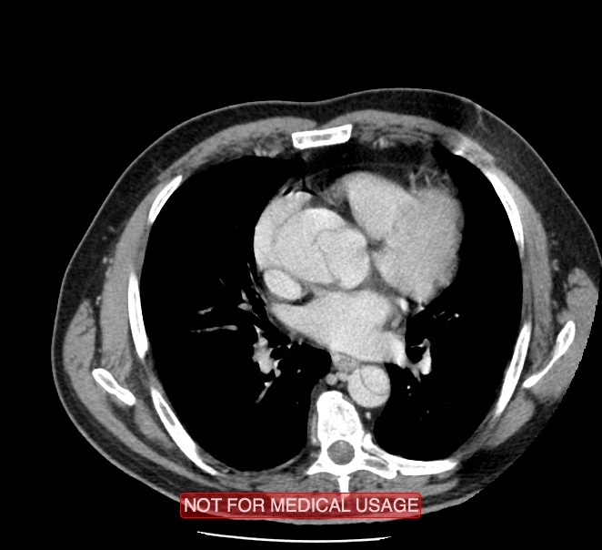 Acute aortic dissection - Stanford type A (Radiopaedia 40661-43285 Axial C+ portal venous phase 30).jpg