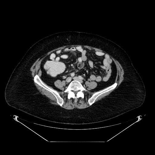 Acute appendicitis, heterotaxy syndrome (Radiopaedia 66884-76202 Axial C+ portal venous phase 85).jpg