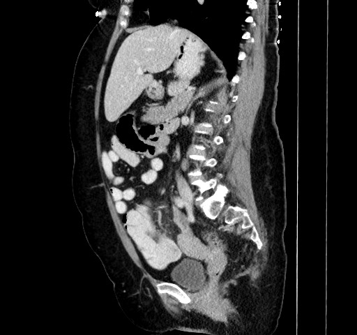 Acute appendicitis, heterotaxy syndrome (Radiopaedia 66884-76202 Sagittal C+ portal venous phase 61).jpg