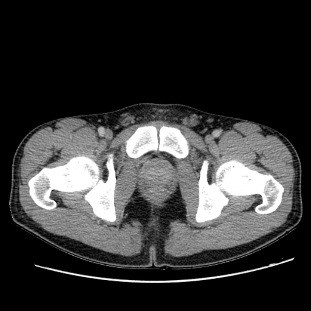 Acute appendicitis (Radiopaedia 27049-27227 Axial C+ portal venous phase 77).jpg