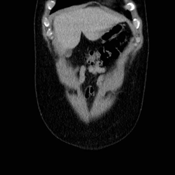 Acute appendicitis (Radiopaedia 38255-40270 Coronal C+ portal venous phase 16).jpg