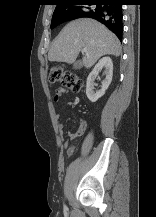 Acute appendicitis (Radiopaedia 48511-53463 Sagittal C+ portal venous phase 48).jpg