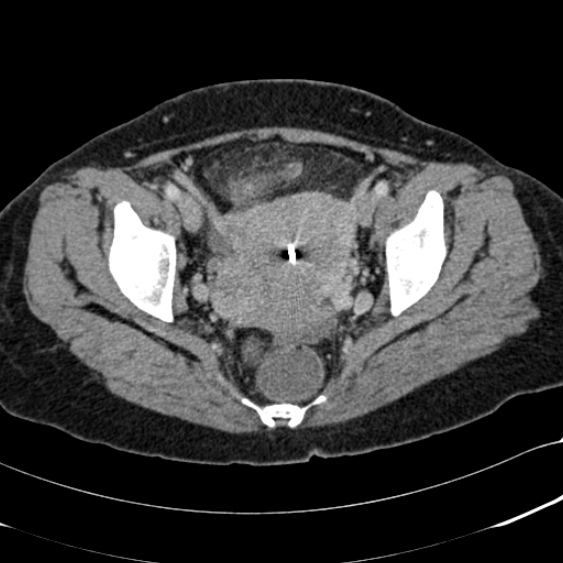 Acute appendicitis (Radiopaedia 48792-53822 Axial C+ portal venous phase 104).jpg