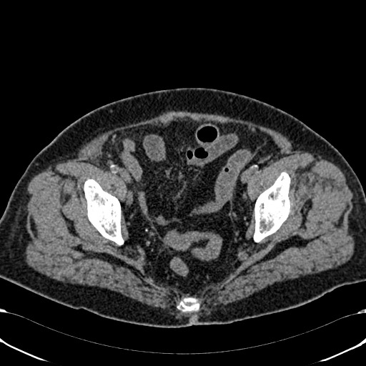 Acute appendicitis (Radiopaedia 58627-65818 Axial non-contrast 77).jpg