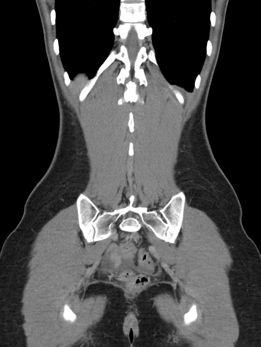 Acute appendicitis (Radiopaedia 62608-70901 Coronal C+ portal venous phase 51).jpg
