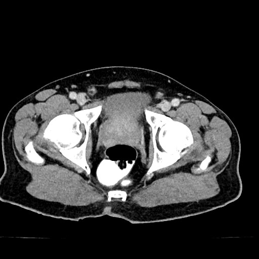 Acute appendicitis (Radiopaedia 77016-88960 Axial C+ portal venous phase 136).jpg