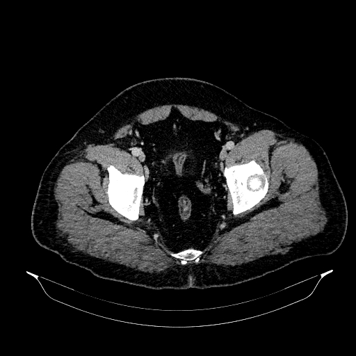 File:Acute appendicitis (Radiopaedia 79950-93224 Axial C+ portal venous phase 92).jpg