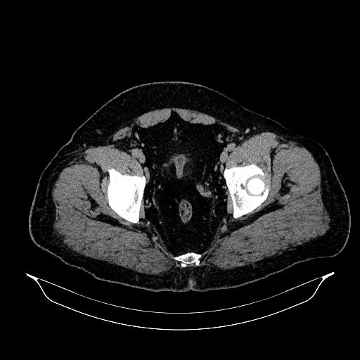 File:Acute appendicitis (Radiopaedia 79950-93224 Axial non-contrast 91).jpg