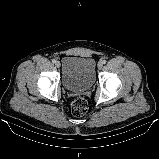 Acute appendicitis (Radiopaedia 84780-100240 Axial C+ portal venous phase 102).jpg