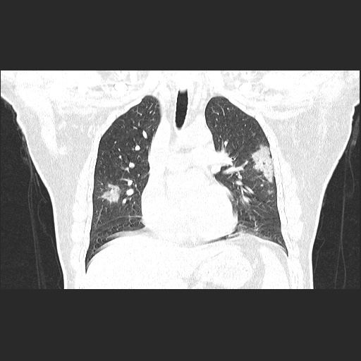 File:Acute appendicitis and COVID 19 pneumonia (Radiopaedia 76604-88380 G 30).jpg