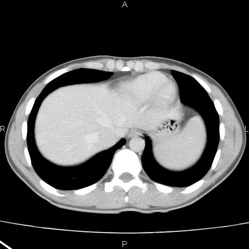 File:Acute appendicitis with CT arrowhead sign (Radiopaedia 21474-21411 Axial C+ portal venous phase 3).jpg