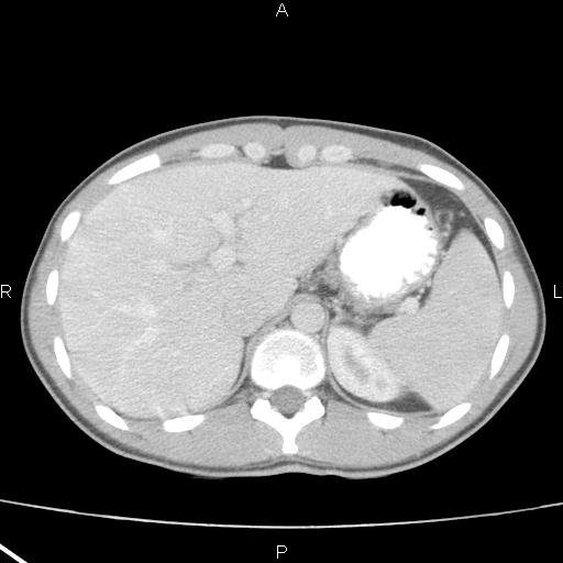 File:Acute appendicitis with CT arrowhead sign (Radiopaedia 21474-21411 Axial C+ portal venous phase 7).jpg