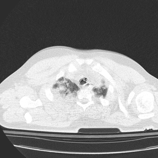 Acute aspiration pneumonitis (Radiopaedia 33605-34703 Axial lung window 17).jpg