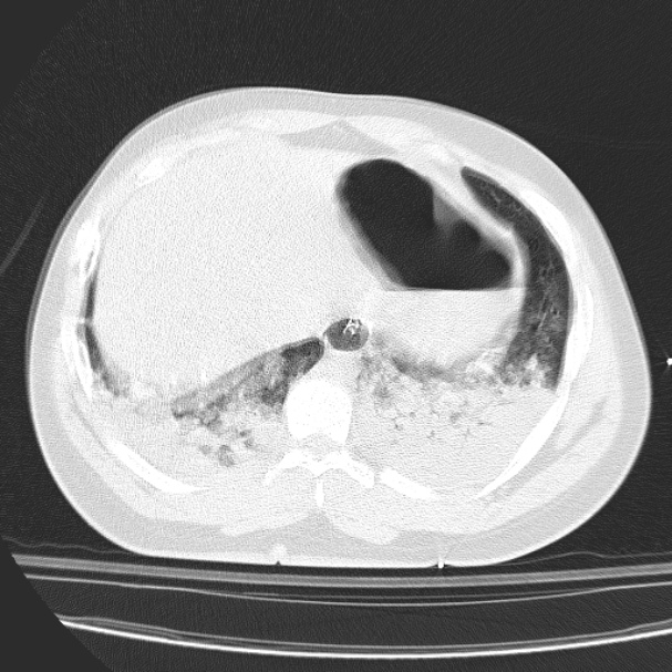 Acute aspiration pneumonitis (Radiopaedia 33605-34703 Axial lung window 80).jpg