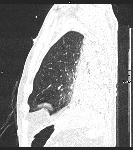 Acute aspiration pneumonitis (Radiopaedia 55642-62166 Sagittal lung window 23).jpg