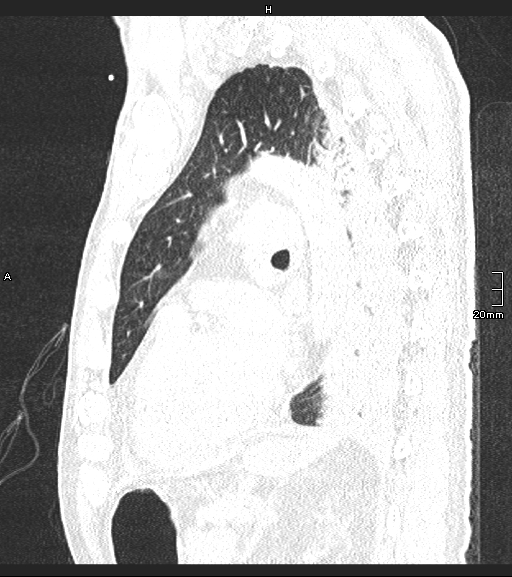 Acute aspiration pneumonitis (Radiopaedia 55642-62166 Sagittal lung window 53).jpg