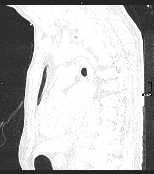 Acute aspiration pneumonitis (Radiopaedia 55642-62166 Sagittal lung window 67).jpg