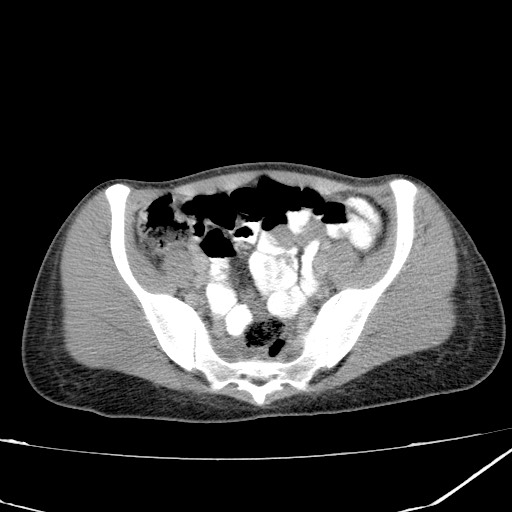 Acute bilateral pyelonephritis (Radiopaedia 74153-84969 Axial C+ portal venous phase 39).jpg