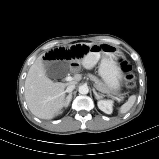 Acute bowel ischemia (Radiopaedia 87695-104114 Axial C+ portal venous phase 25).jpg