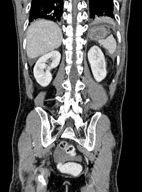 Acute bowel ischemia (Radiopaedia 87695-104114 Coronal C+ portal venous phase 288).jpg