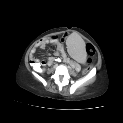 Acute calculous cholecystitis in patient with osteopetrosis (Radiopaedia 77871-90159 Axial C+ portal venous phase 55).jpg