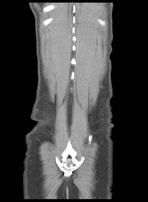 Acute cholecystitis (Radiopaedia 29814-30327 Coronal C+ portal venous phase 48).jpg