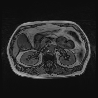 File:Acute cholecystitis (Radiopaedia 72392-82923 Axial T1 out-of-phase 59).jpg