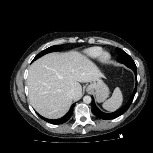 File:Acute cholecystitis and incidental left sided IVC (Radiopaedia 49352-54459 Axial C+ portal venous phase 32).jpg