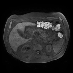 Acute cholecystitis complicated by pylephlebitis (Radiopaedia 65782-74915 Axial T1 fat sat 53).jpg