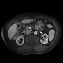 File:Acute cholecystitis complicated by pylephlebitis (Radiopaedia 65782-74915 Axial arterioportal phase T1 C+ fat sat 80).jpg