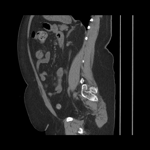 Acute cholecystitis with tensile fundus sign (Radiopaedia 71394-81723 Sagittal non-contrast 105).jpg