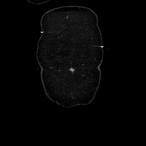 Acute diverticulitis - transverse colon (Radiopaedia 87063-103327 Coronal C+ portal venous phase 22).jpg