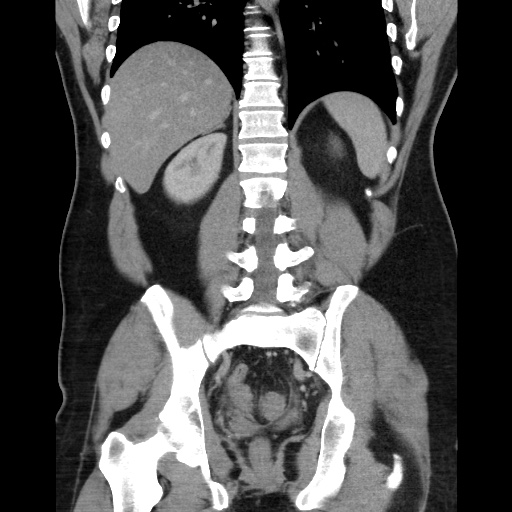 Acute diverticulitis with localized perforation (Radiopaedia 41296-44113 Coronal C+ portal venous phase 44).jpg