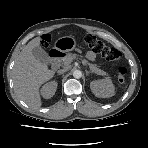 Acute epicardial fat necrosis (Radiopaedia 42327-45440 Axial C+ CTPA 96).jpg