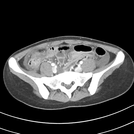 Acute gangrenous appendicitis with perforation (Radiopaedia 40152-42662 Axial C+ portal venous phase 51).png