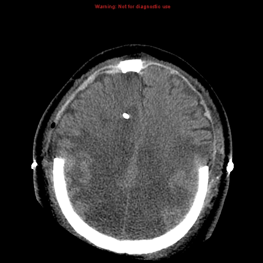 Acute hemorrhagic leukoencephalitis (Radiopaedia 14076-43697 Axial non-contrast 35).jpg