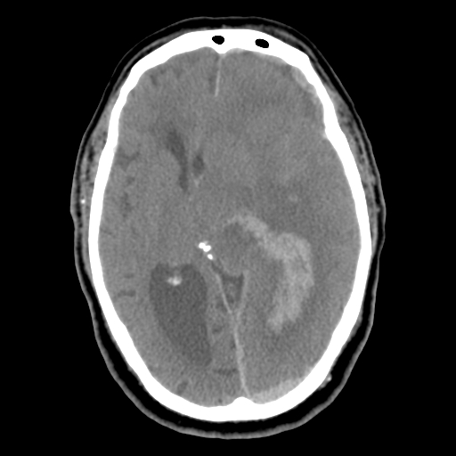 Acute hemorrhagic stroke (Radiopaedia 17507-17223 Axial non-contrast 25).jpg