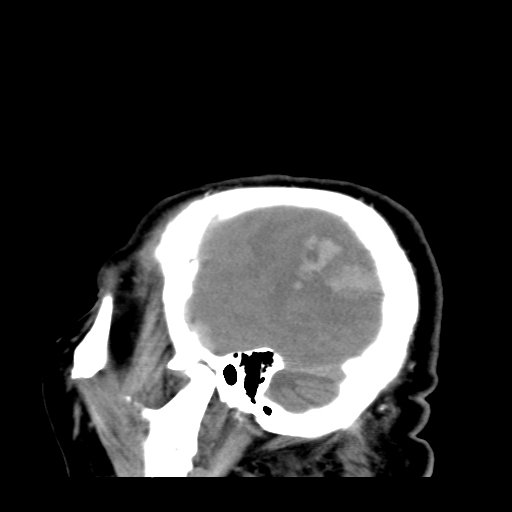 File:Acute hemorrhagic stroke (Radiopaedia 17507-17223 Sagittal non-contrast 6).jpg