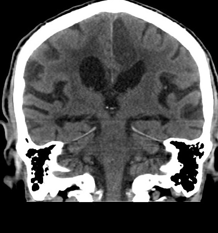 Acute left anterior cerebral artery territory infarction (Radiopaedia 51785-57578 Coronal non-contrast 36).jpg
